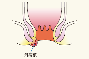 肛門疾患 金武外科肛門科 佐賀市城内の大腸肛門科 外科