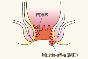 肛門 痒み