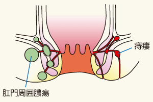 あな けつ かゆい の が 肛門にかゆみを感じる６つの原因とは？病気の可能性も！